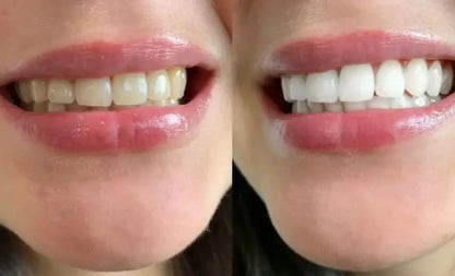 SmileKit 9D White – Bandes Blanchissantes Professionnelles pour les Dents