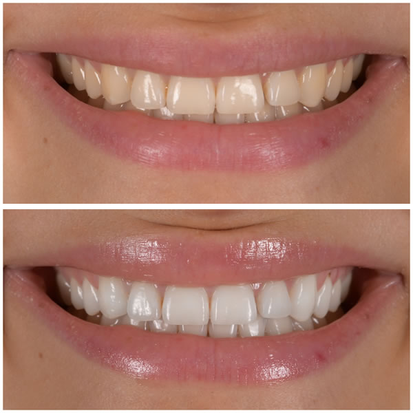 Dentifrice Éclaircissant à la Niacinamide – UTOGRU®