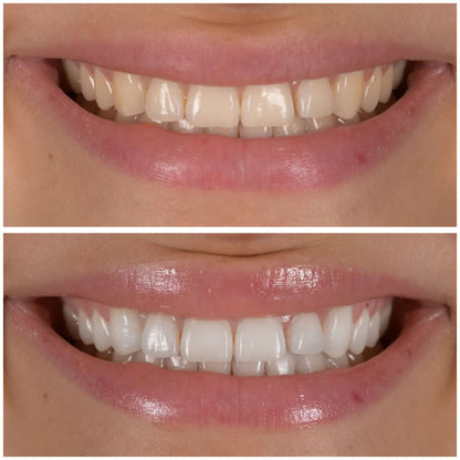 Dentifrice Éclaircissant à la Niacinamide – UTOGRU®